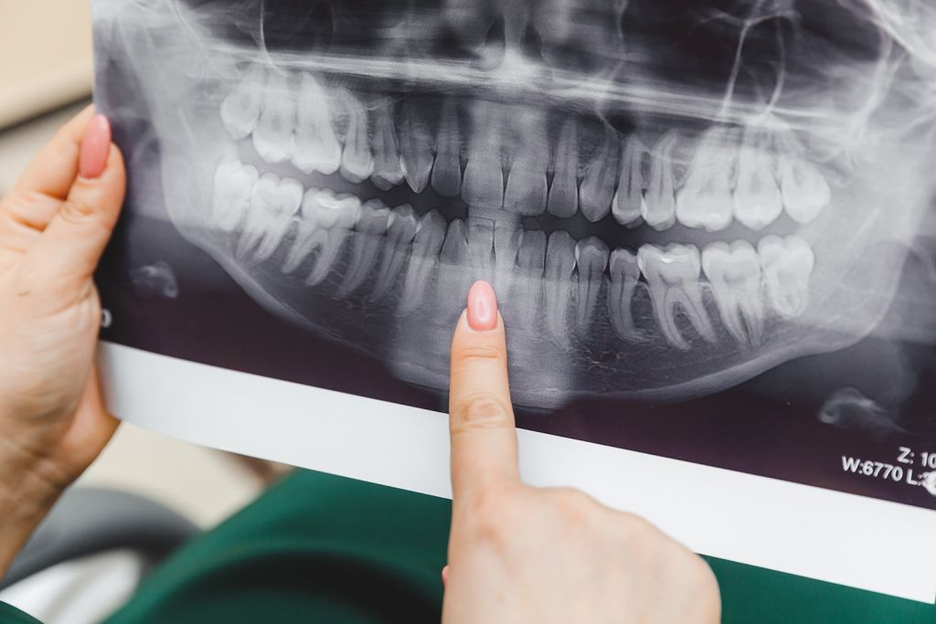 Indianapolis Digital X-Rays - SoBro Dental - Broad Ripple / SoBro Dentistry - Indianapolis, Indiana