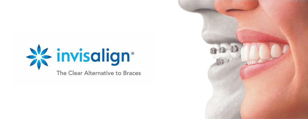 Invisalign Treatment Invisible Braces - SoBro Dental - Broad Ripple / SoBro Dentistry - Indianapolis, Indiana