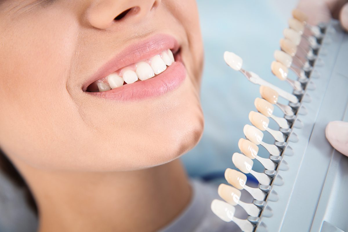 Dentist comparing tooth shades for professional teeth whitening - SoBro Dental